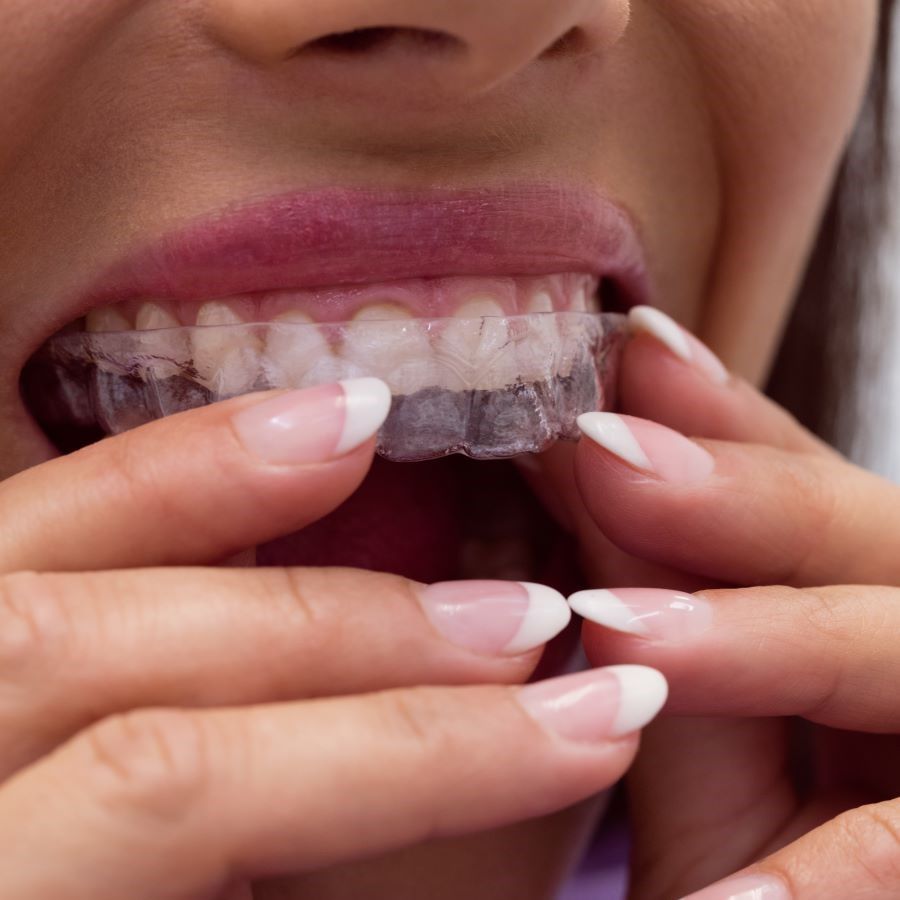 clear-aligners