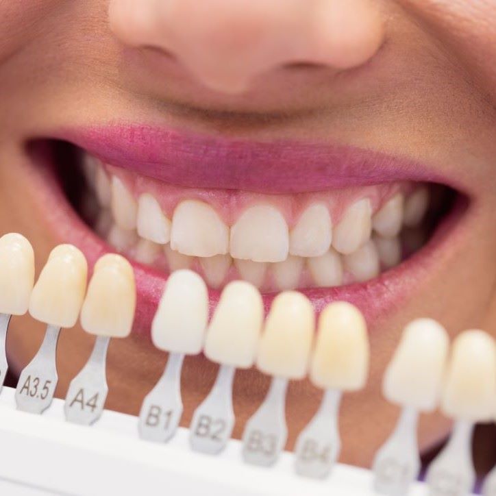 teeth-whitening